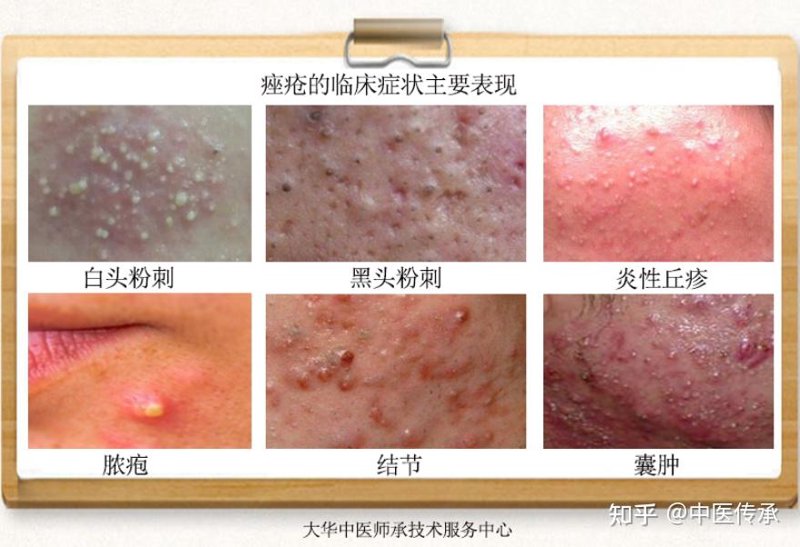 青春痘中医治疗